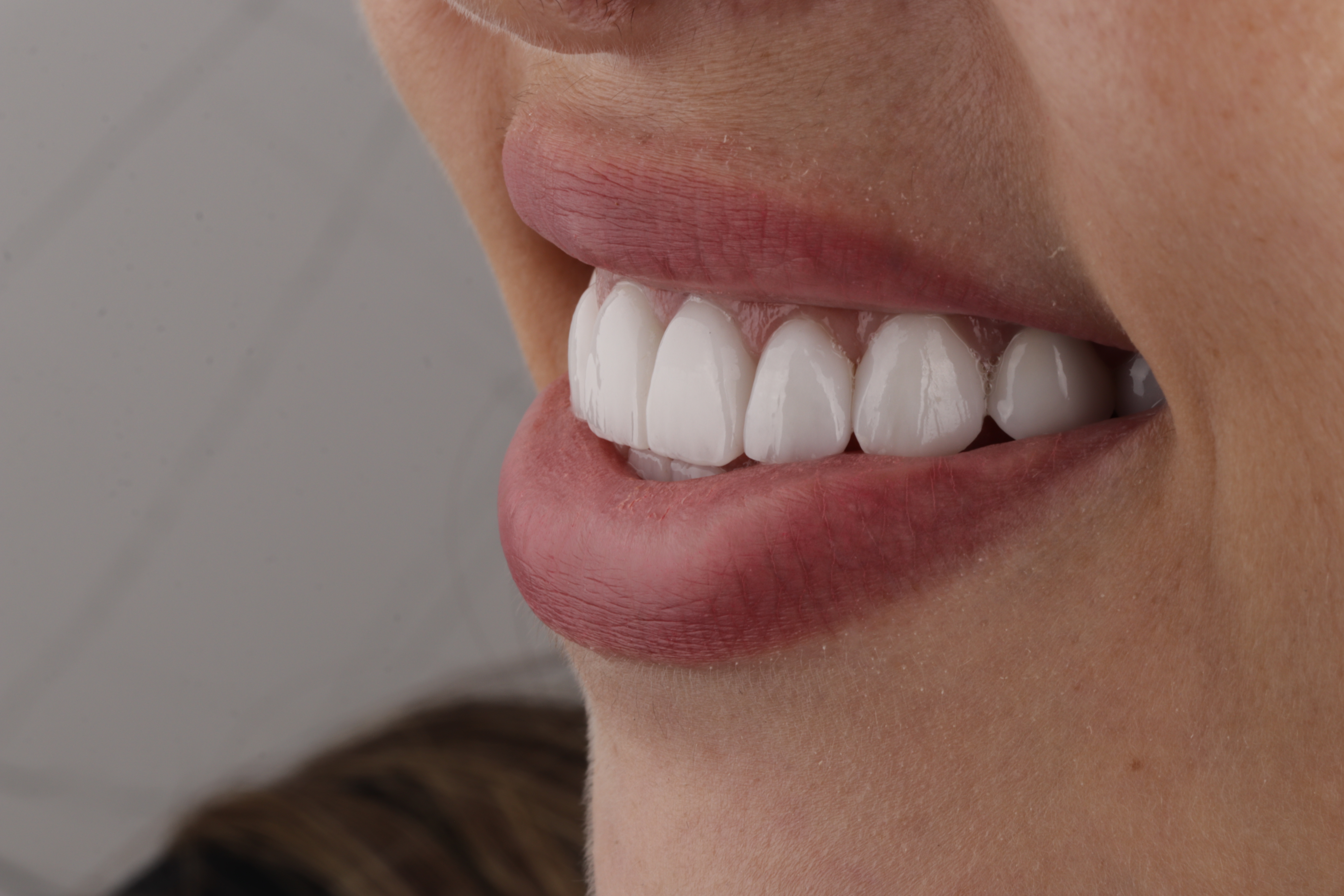 AuraDent Clinic smile result