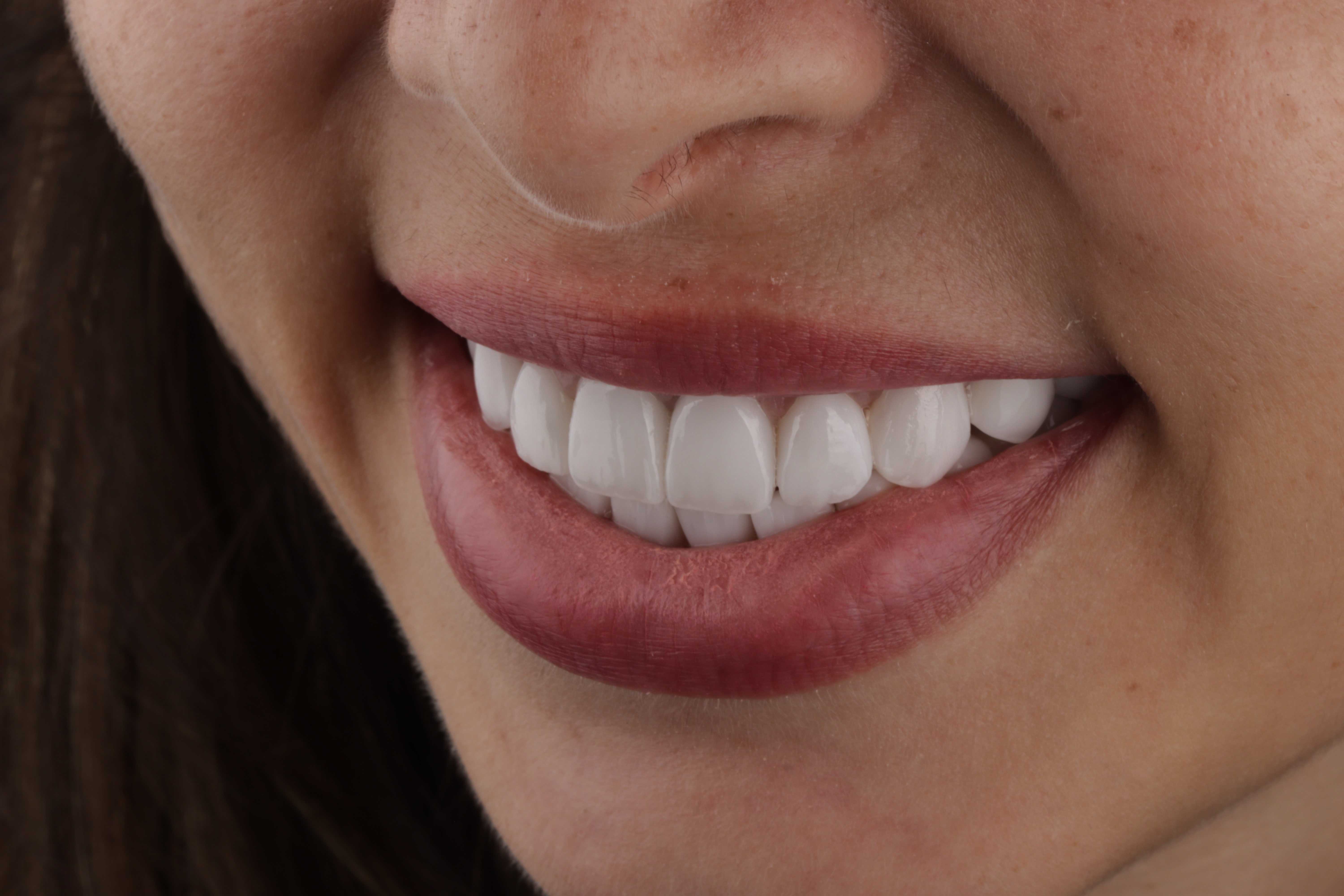 AuraDent Clinic smile result
