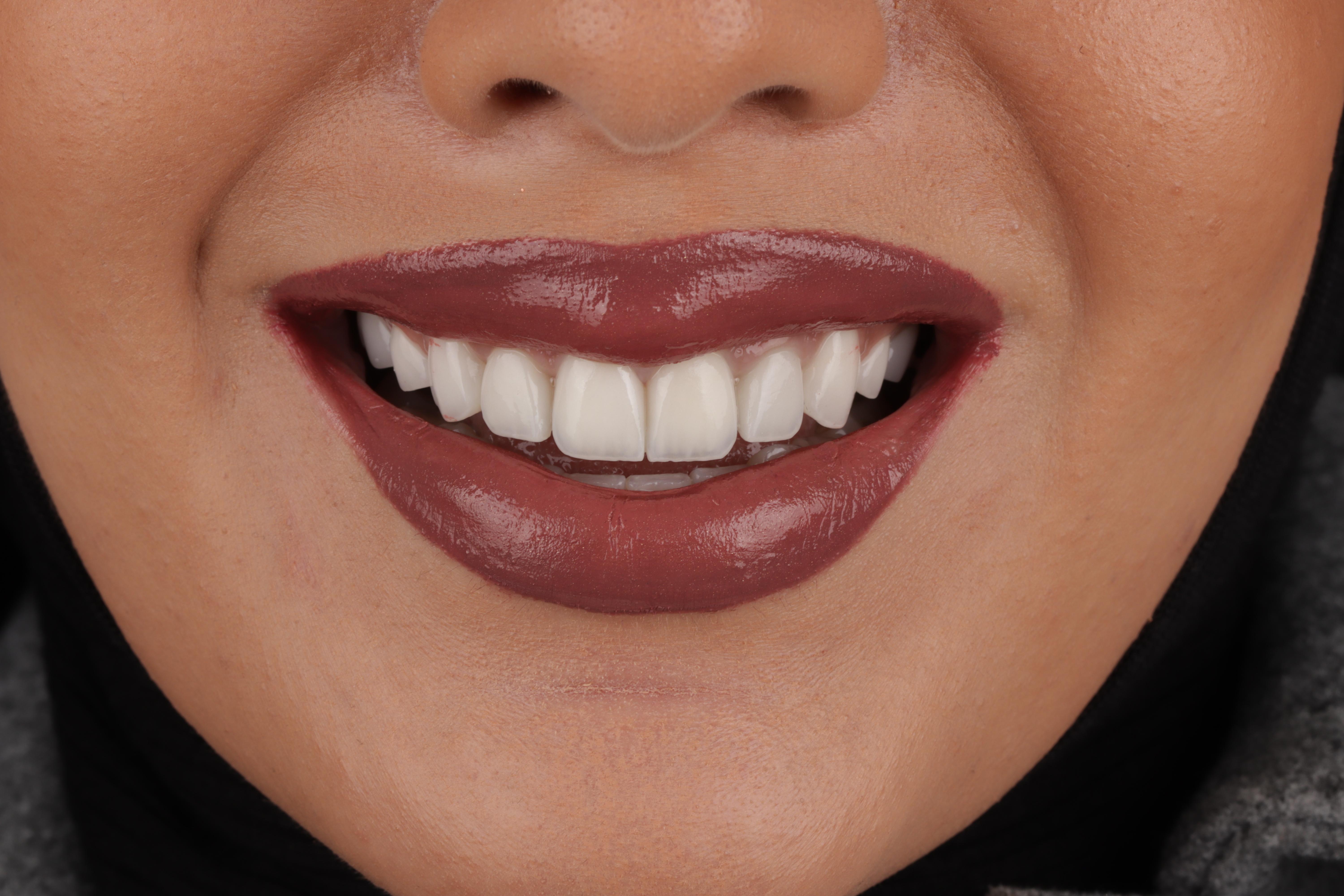 AuraDent Clinic smile result
