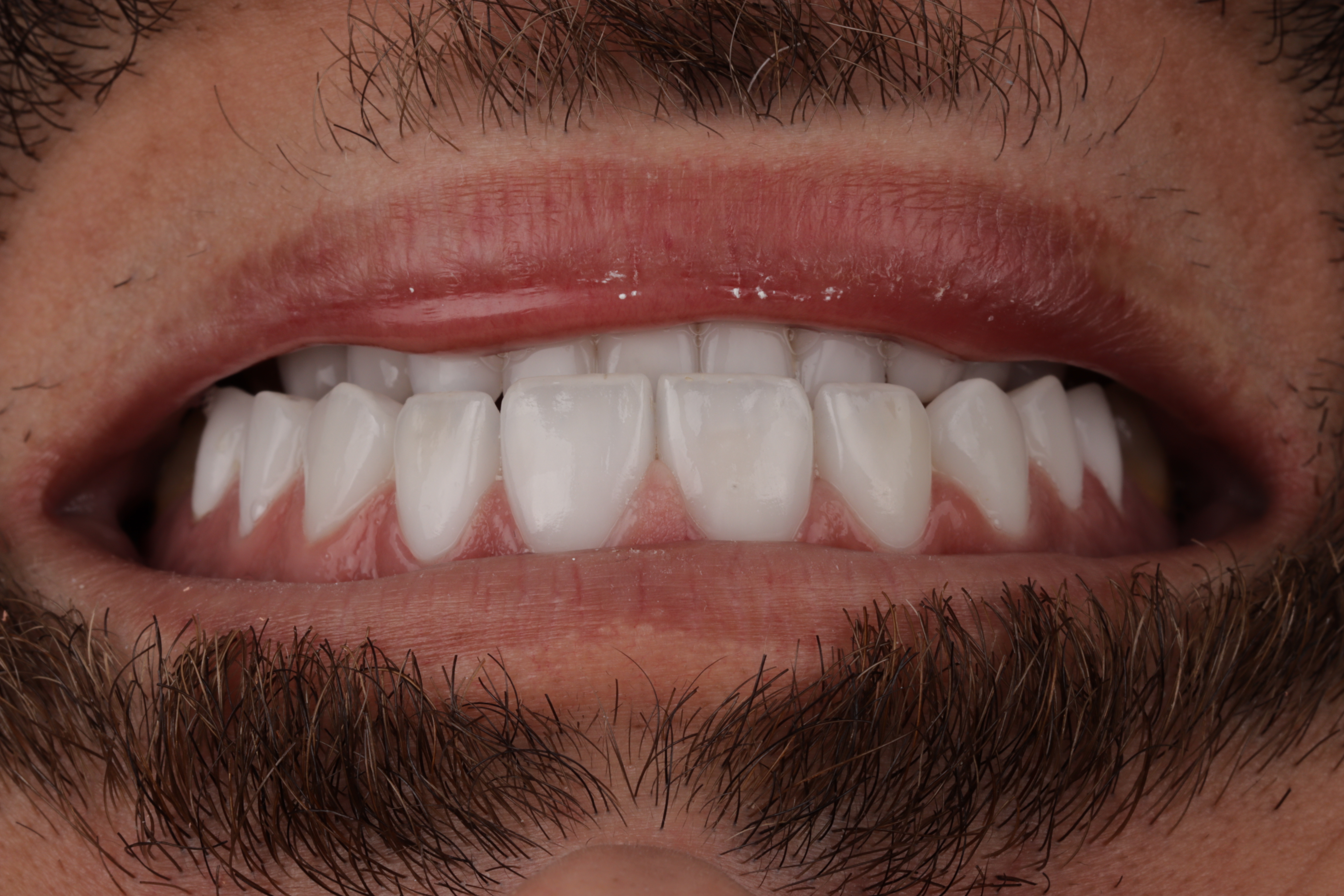 AuraDent Clinic smile result