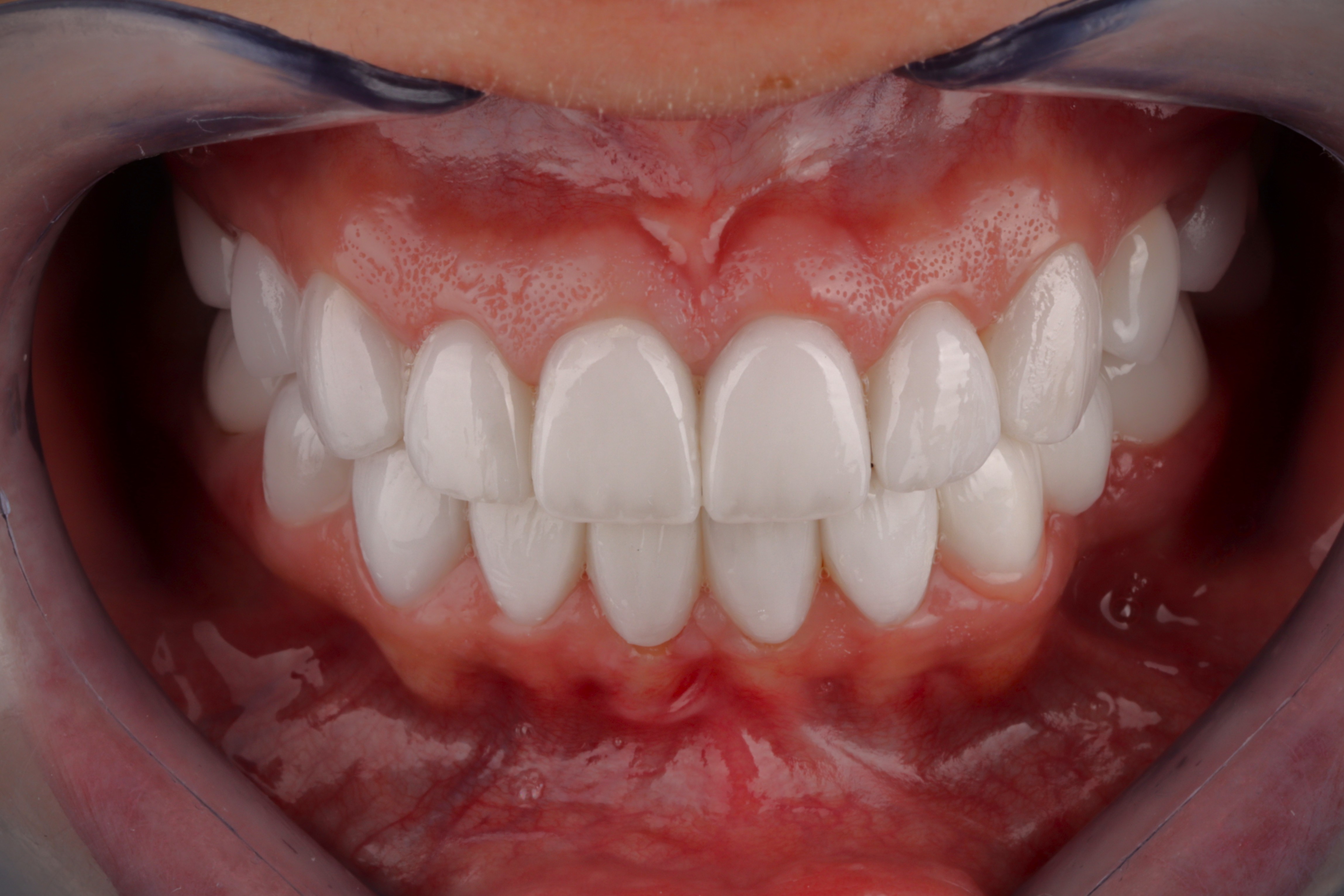 AuraDent Clinic smile result