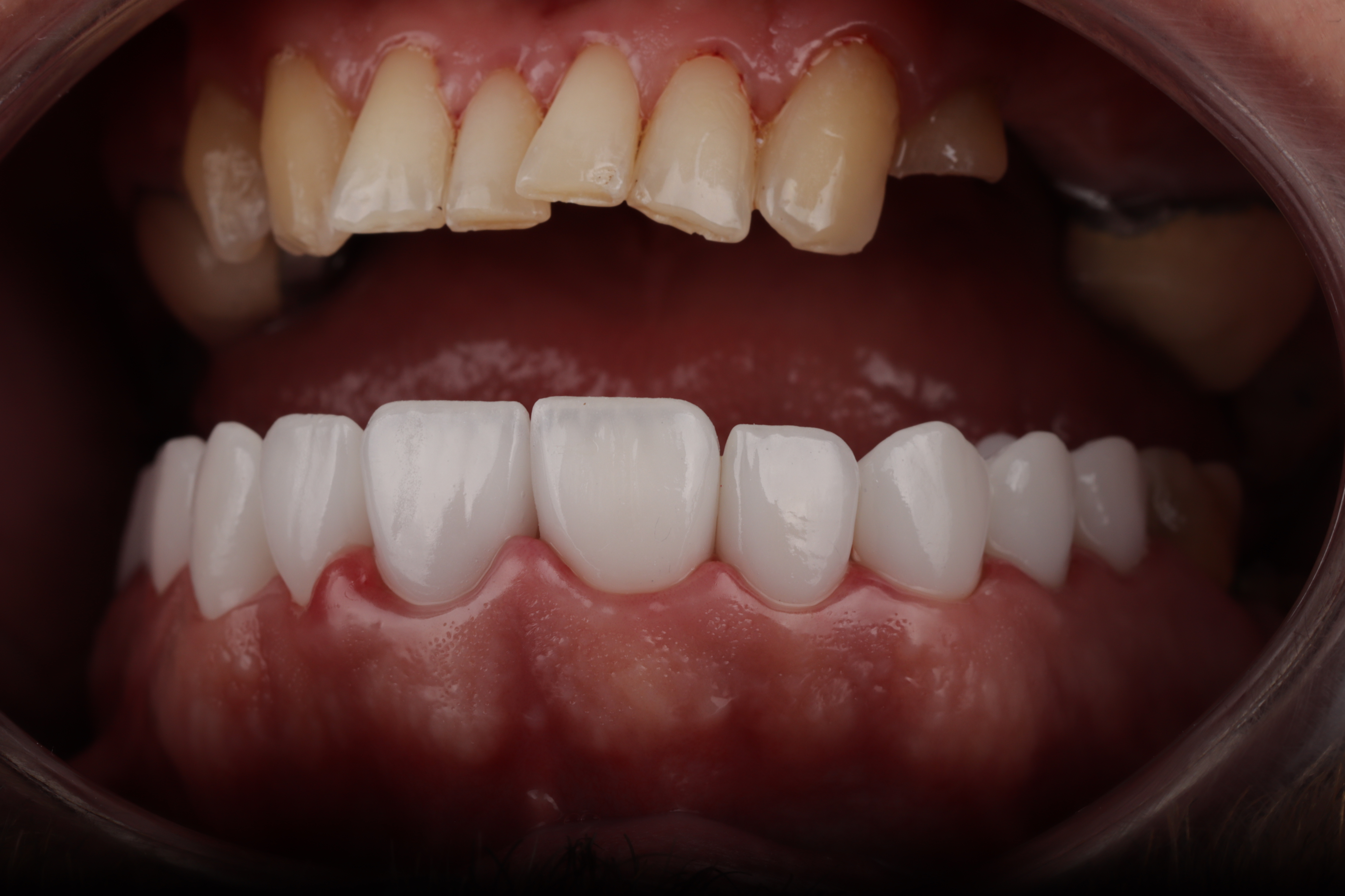AuraDent Clinic smile result