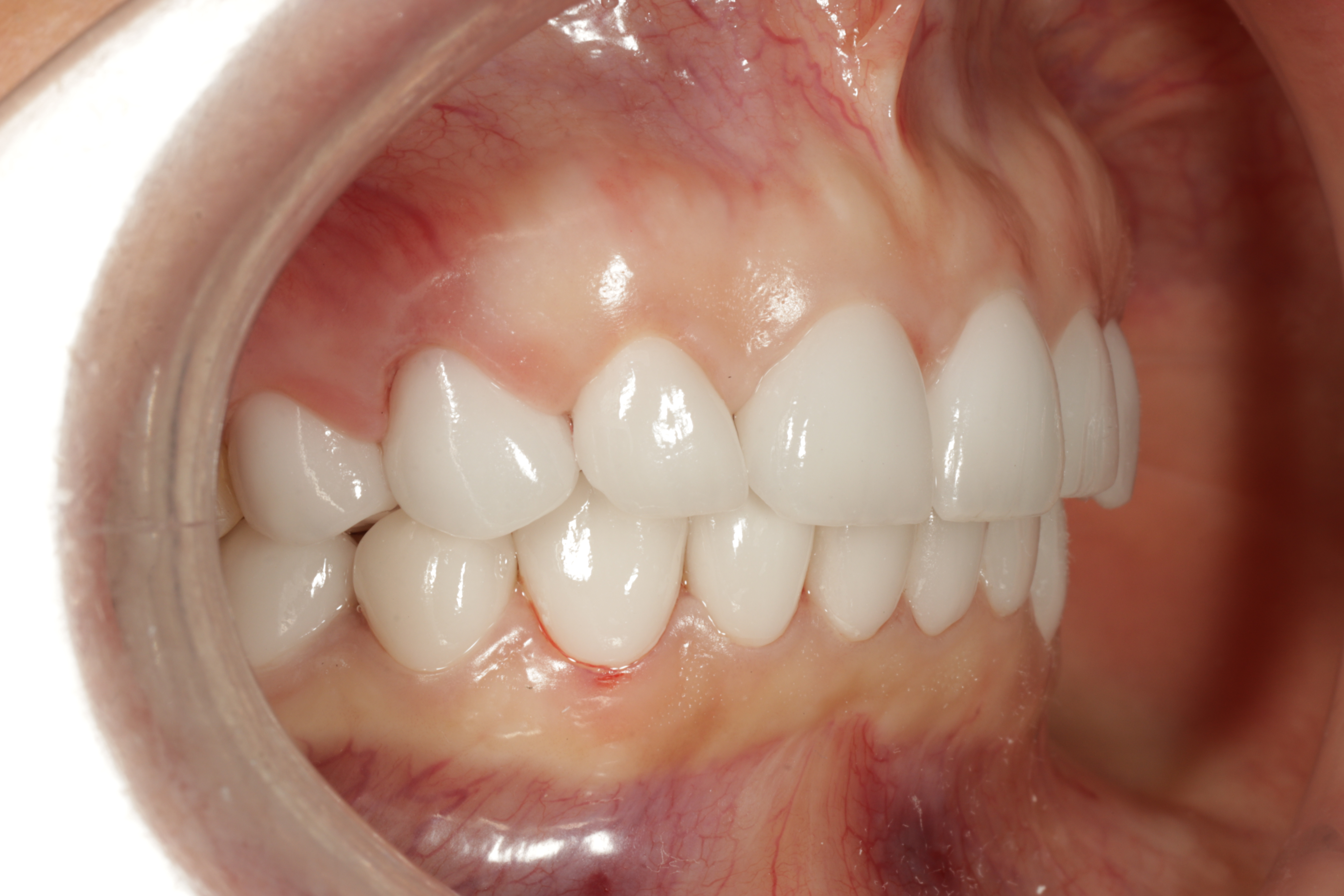 AuraDent Clinic smile result